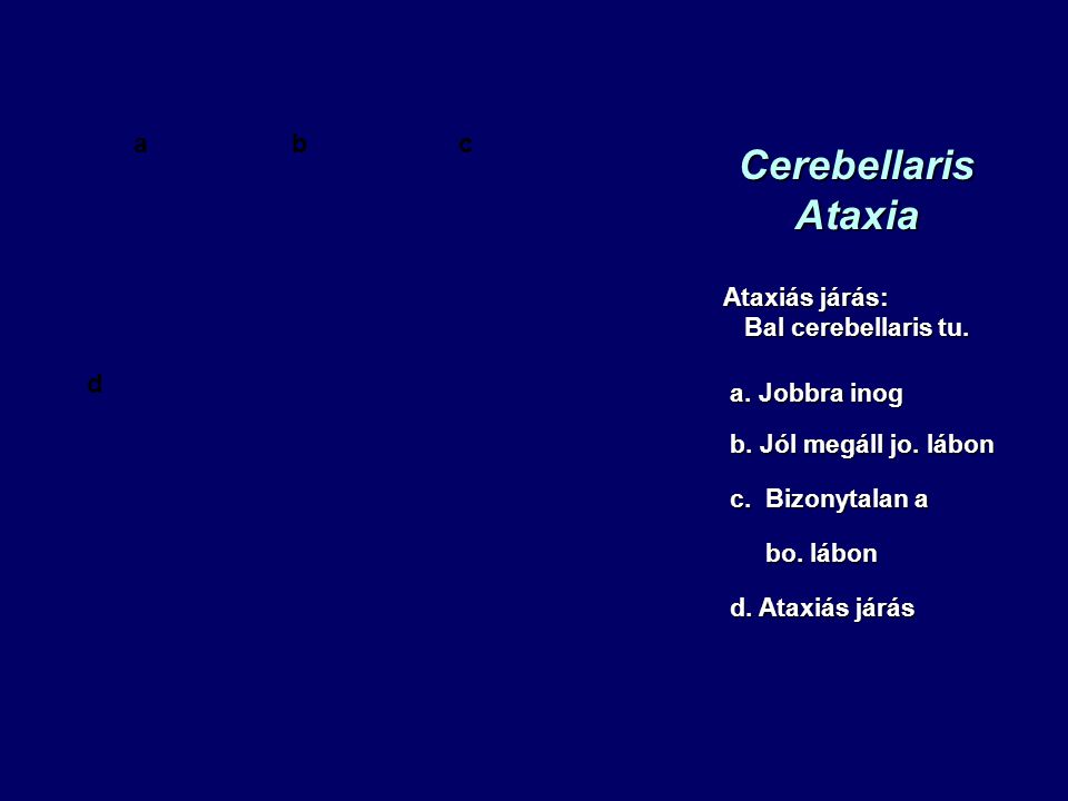 Cerebellaris Ataxia a b c d Ataxiás járás: Bal cerebellaris tu.