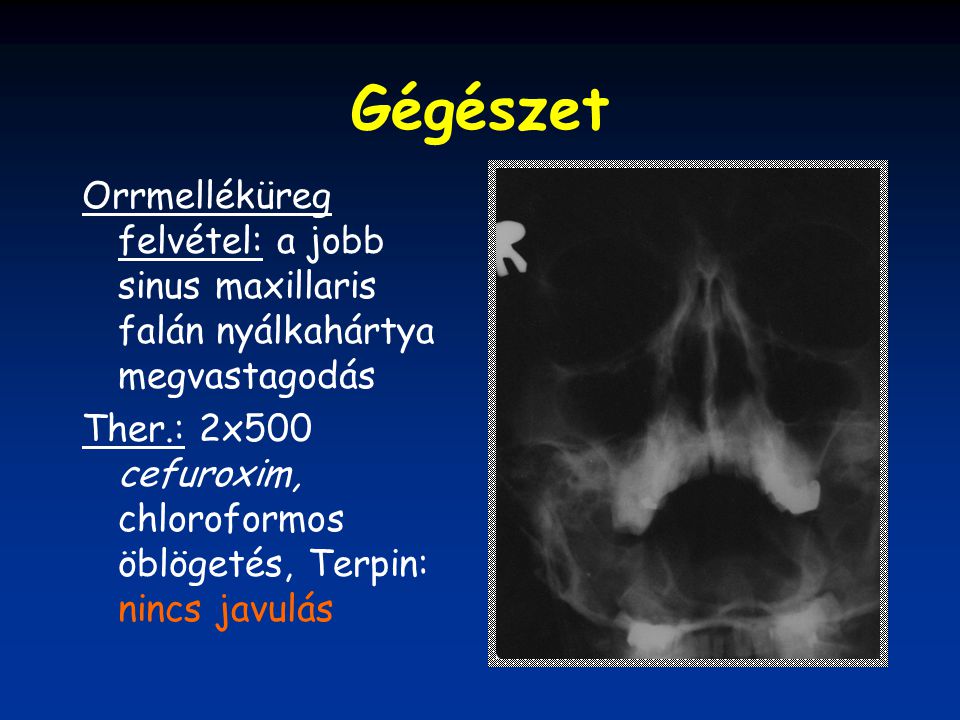 Gégészet Orrmelléküreg felvétel: a jobb sinus maxillaris falán nyálkahártya megvastagodás.