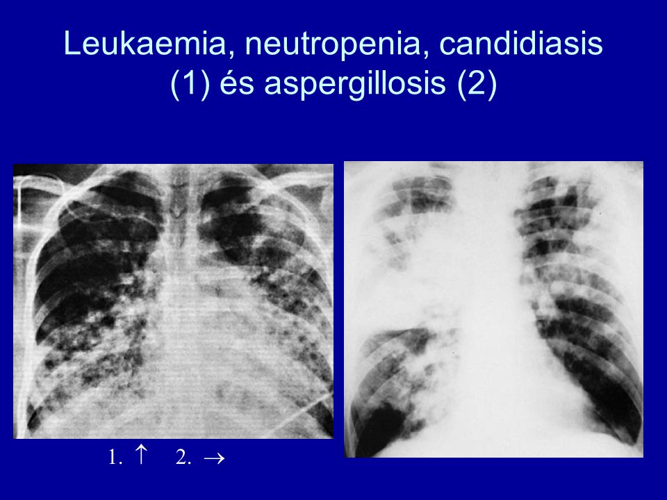 Leukaemia, neutropenia, candidiasis (1) és aspergillosis (2)
