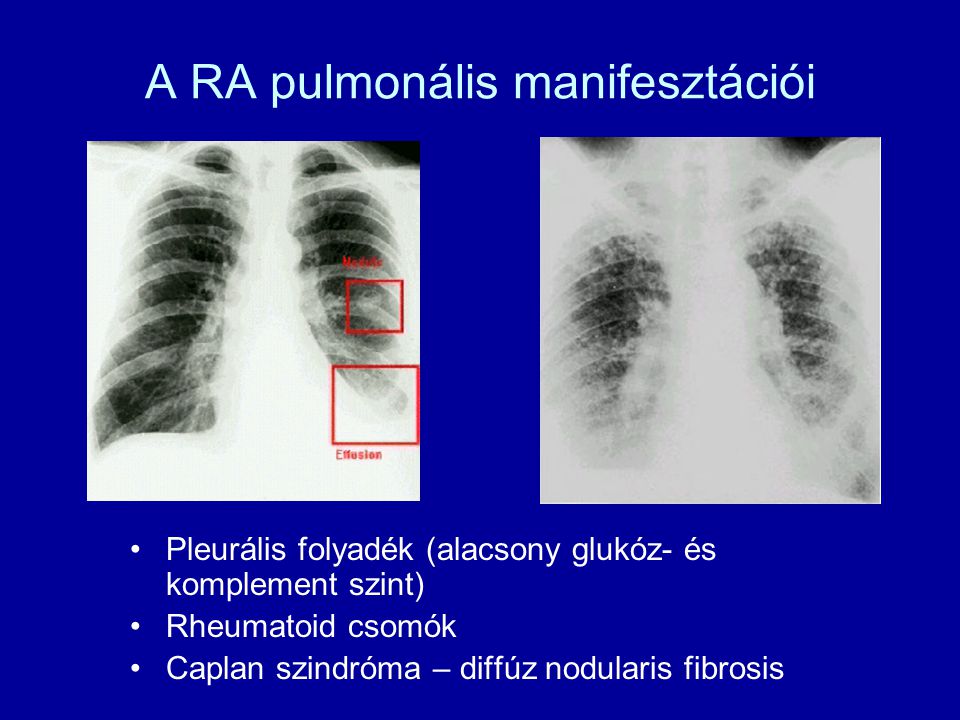 A RA pulmonális manifesztációi