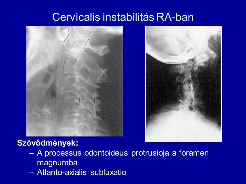 Cervicalis instabilitás RA-ban