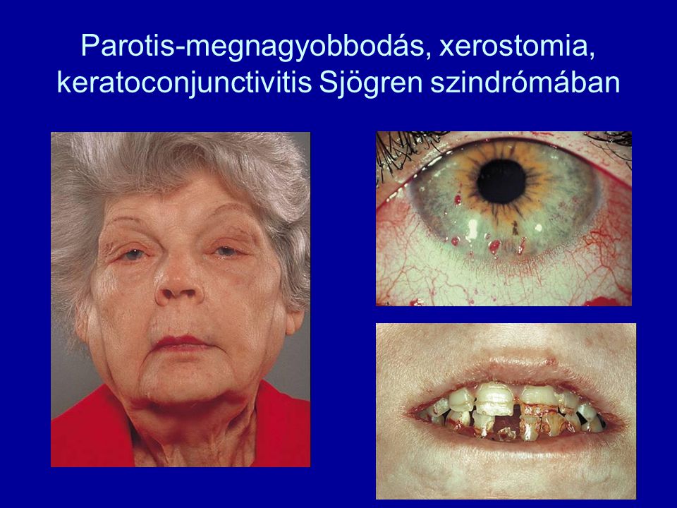 Parotis-megnagyobbodás, xerostomia, keratoconjunctivitis Sjögren szindrómában