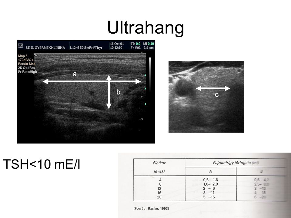 Ultrahang a b c TSH<10 mE/l