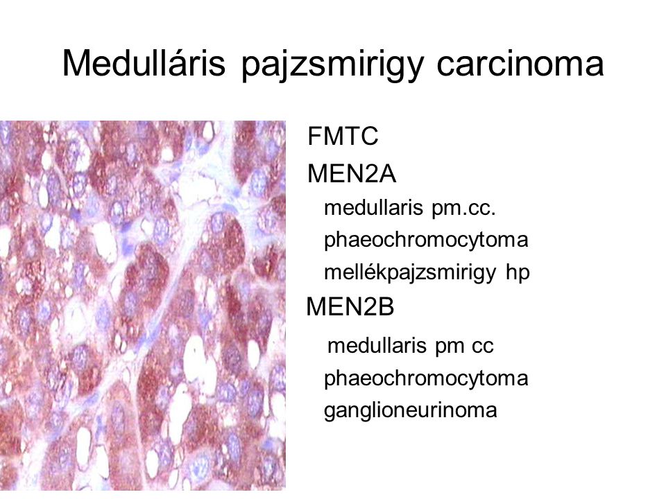 Medulláris pajzsmirigy carcinoma