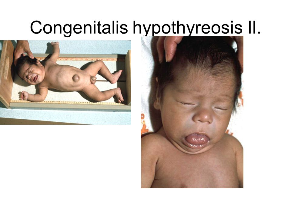 Congenitalis hypothyreosis II.