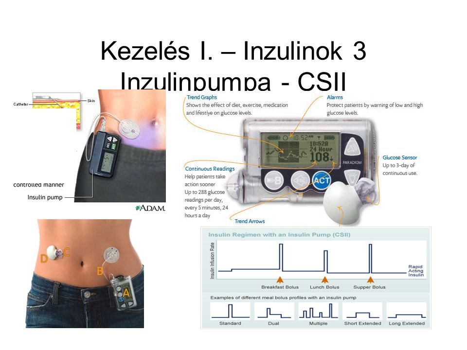 Kezelés I. – Inzulinok 3 Inzulinpumpa - CSII
