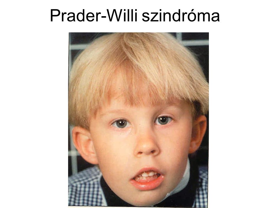Prader-Willi szindróma