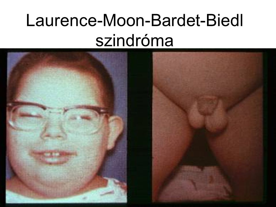 Laurence-Moon-Bardet-Biedl szindróma