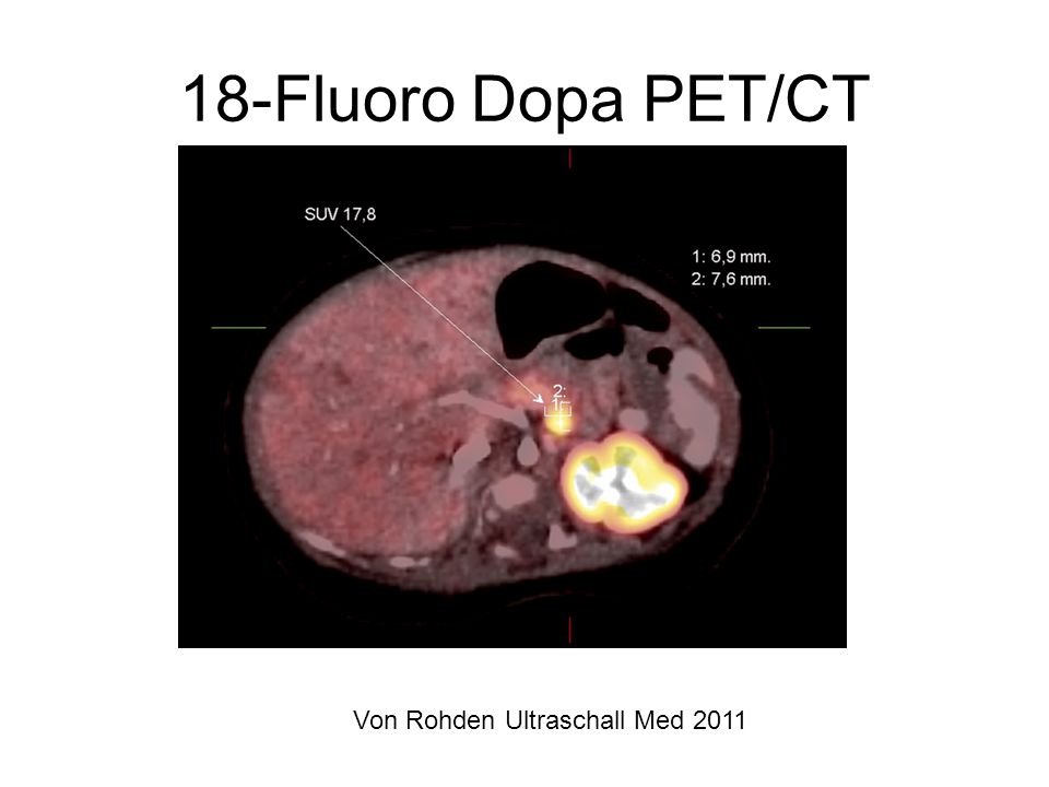 18-Fluoro Dopa PET/CT Von Rohden Ultraschall Med 2011