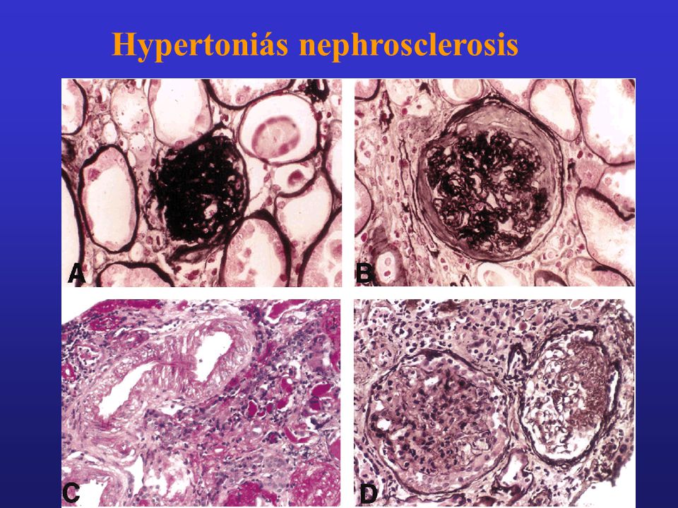 Hypertoniás nephrosclerosis