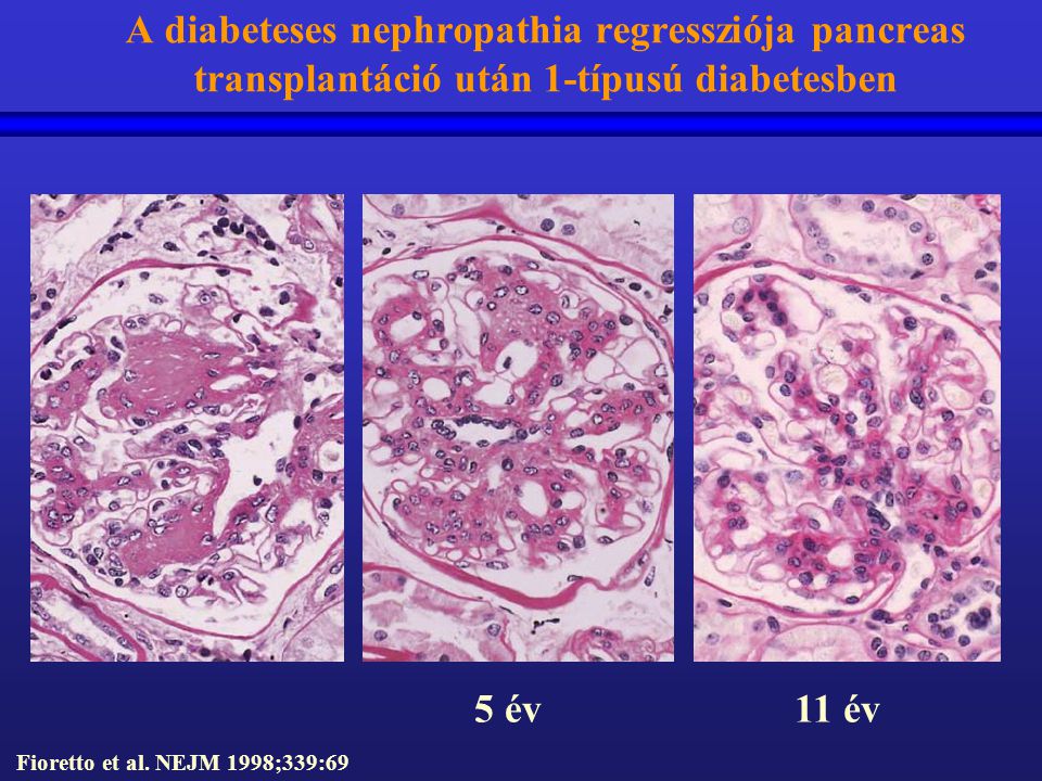 A diabeteses nephropathia regressziója pancreas transplantáció után 1-típusú diabetesben