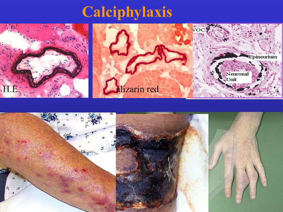 Calciphylaxis H.E. alizarin red