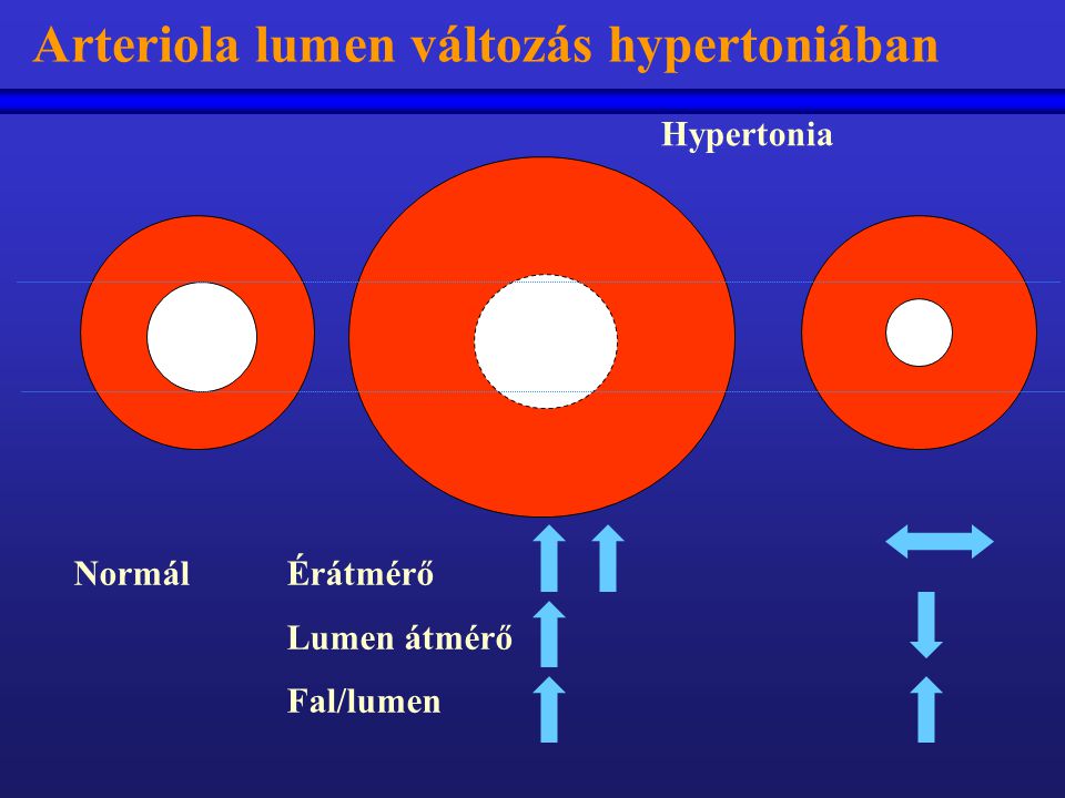 Arteriola lumen változás hypertoniában