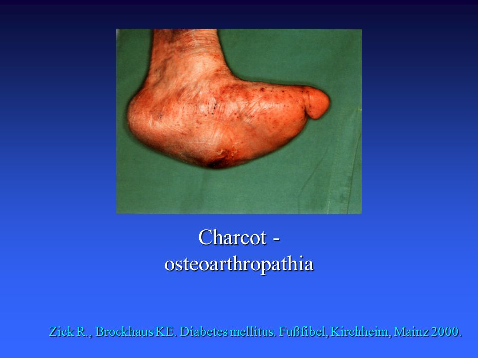 Charcot - osteoarthropathia