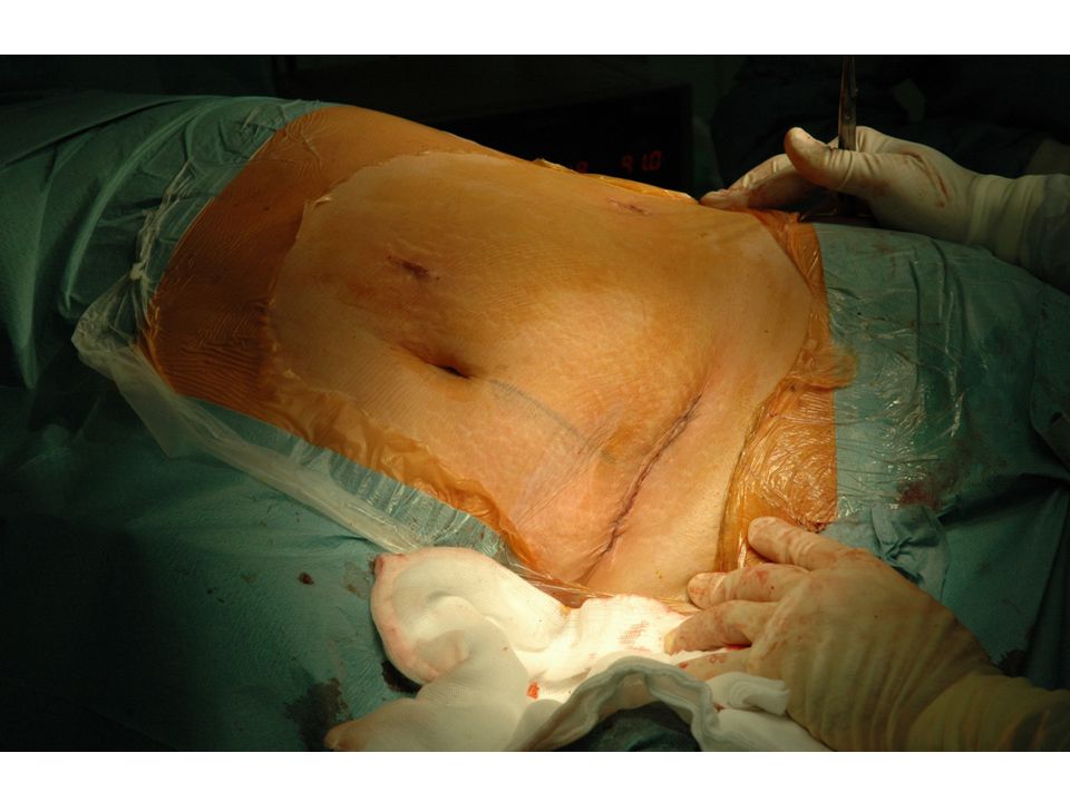 Rev köv-n műtéti seb zárása, intracután tovafutó öltések, felszívódó fonallal.