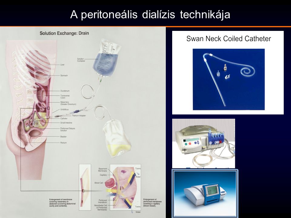 A peritoneális dialízis technikája
