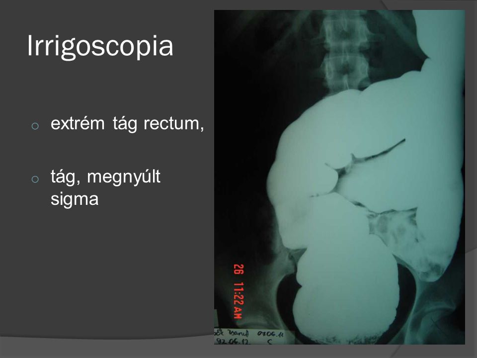 Irrigoscopia extrém tág rectum, tág, megnyúlt sigma