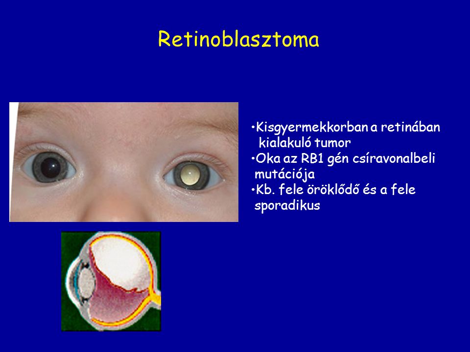 Retinoblasztoma Kisgyermekkorban a retinában kialakuló tumor