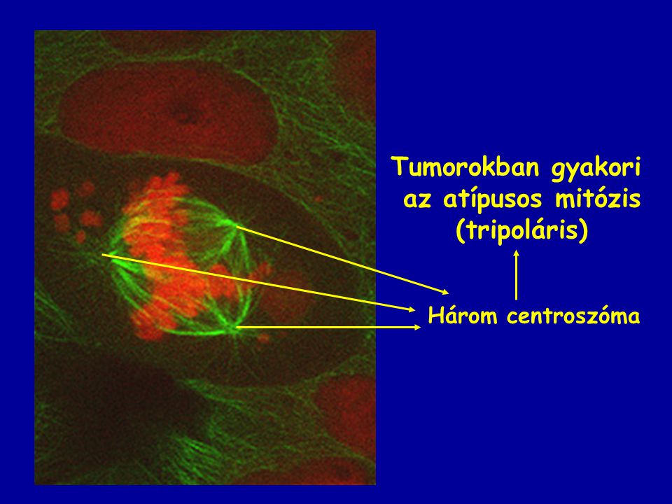 Tumorokban gyakori az atípusos mitózis (tripoláris)
