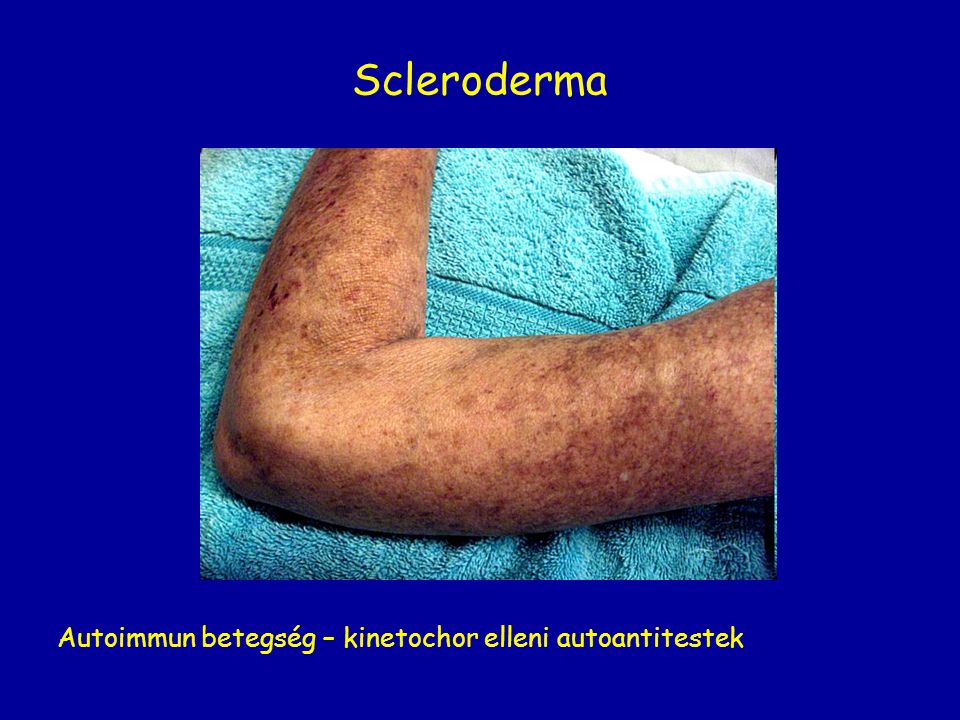 Scleroderma Autoimmun betegség – kinetochor elleni autoantitestek