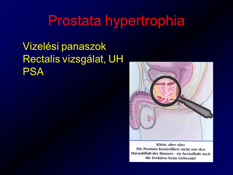 Prostata hypertrophia