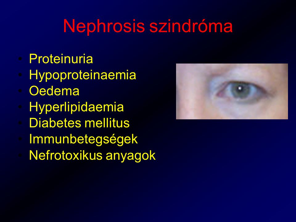 Nephrosis szindróma Proteinuria Hypoproteinaemia Oedema