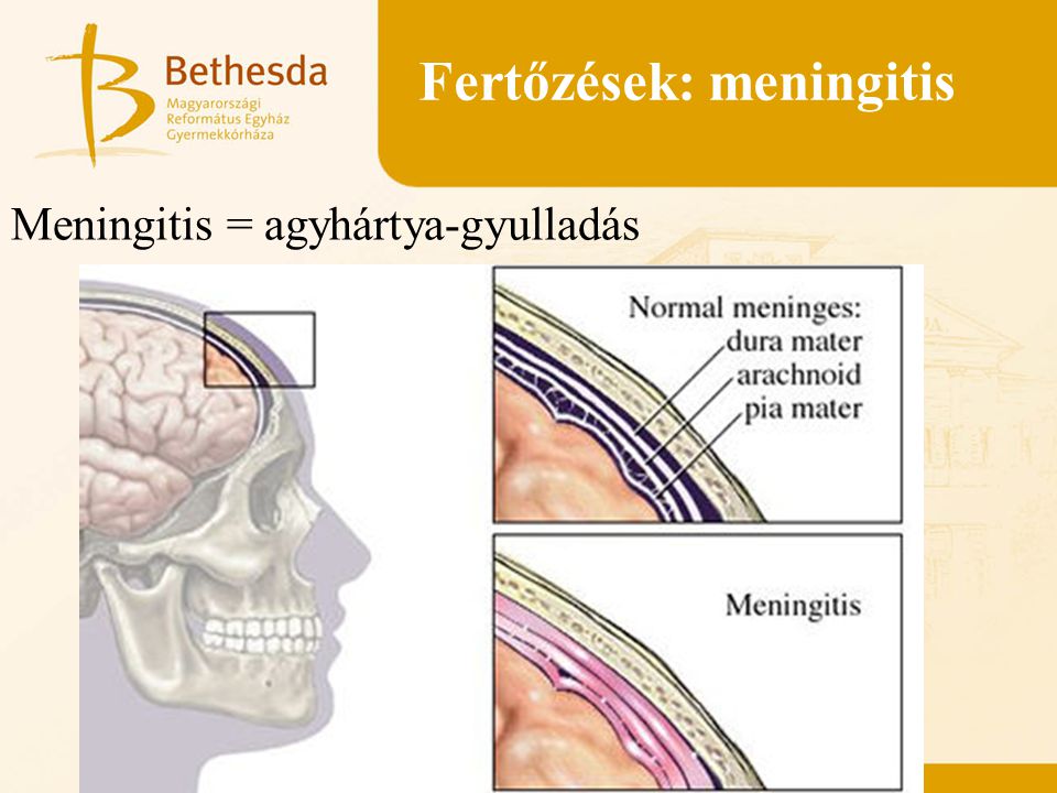 Fertőzések: meningitis