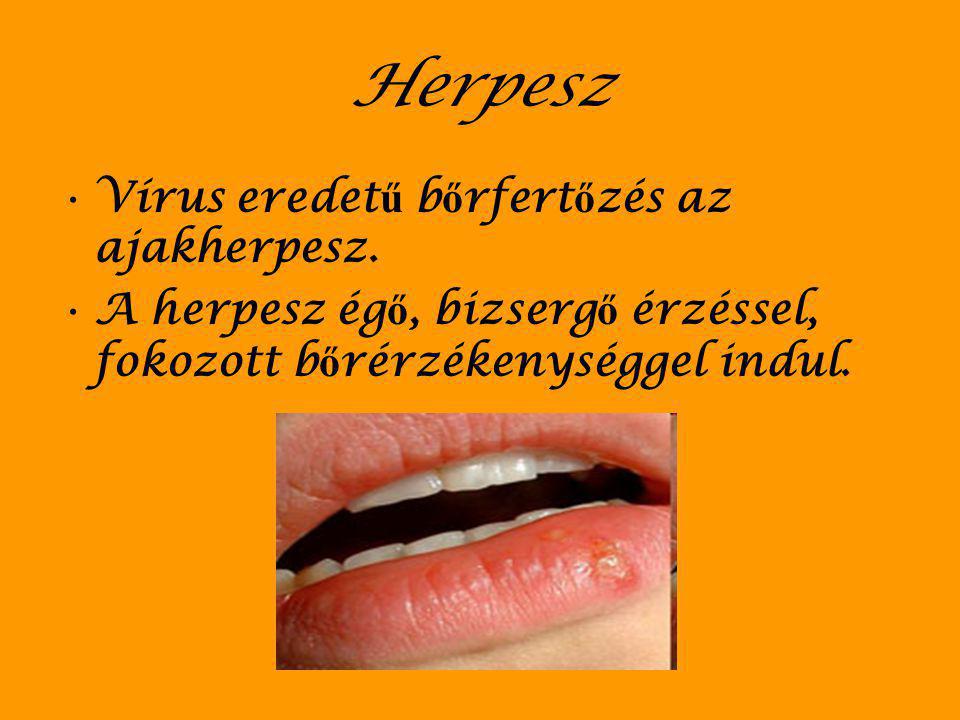 Herpesz Vírus eredetű bőrfertőzés az ajakherpesz.