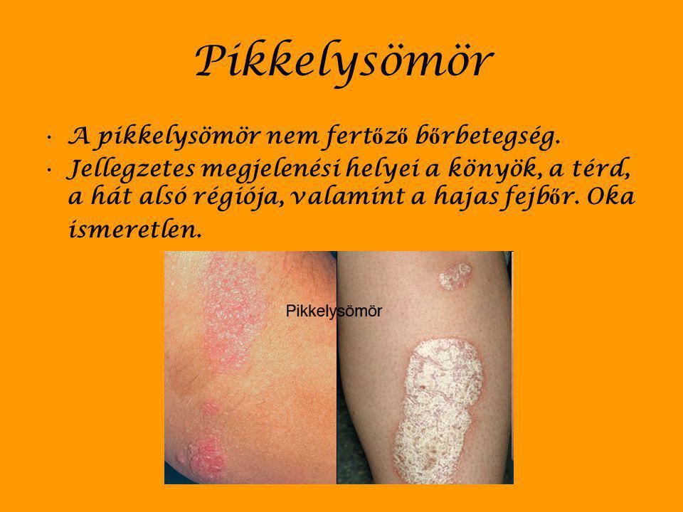 Pikkelysömör A pikkelysömör nem fertőző bőrbetegség.