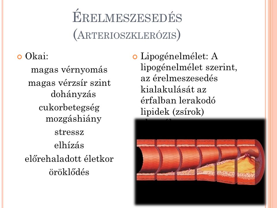 Érelmeszesedés (Arterioszklerózis)