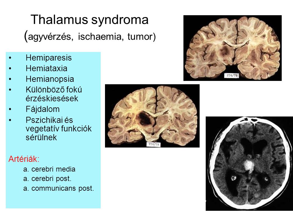 Thalamus syndroma (agyvérzés, ischaemia, tumor)