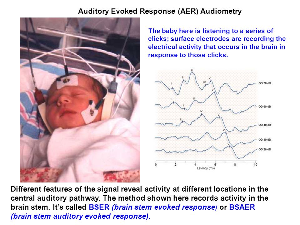 Auditory Evoked Response (AER) Audiometry