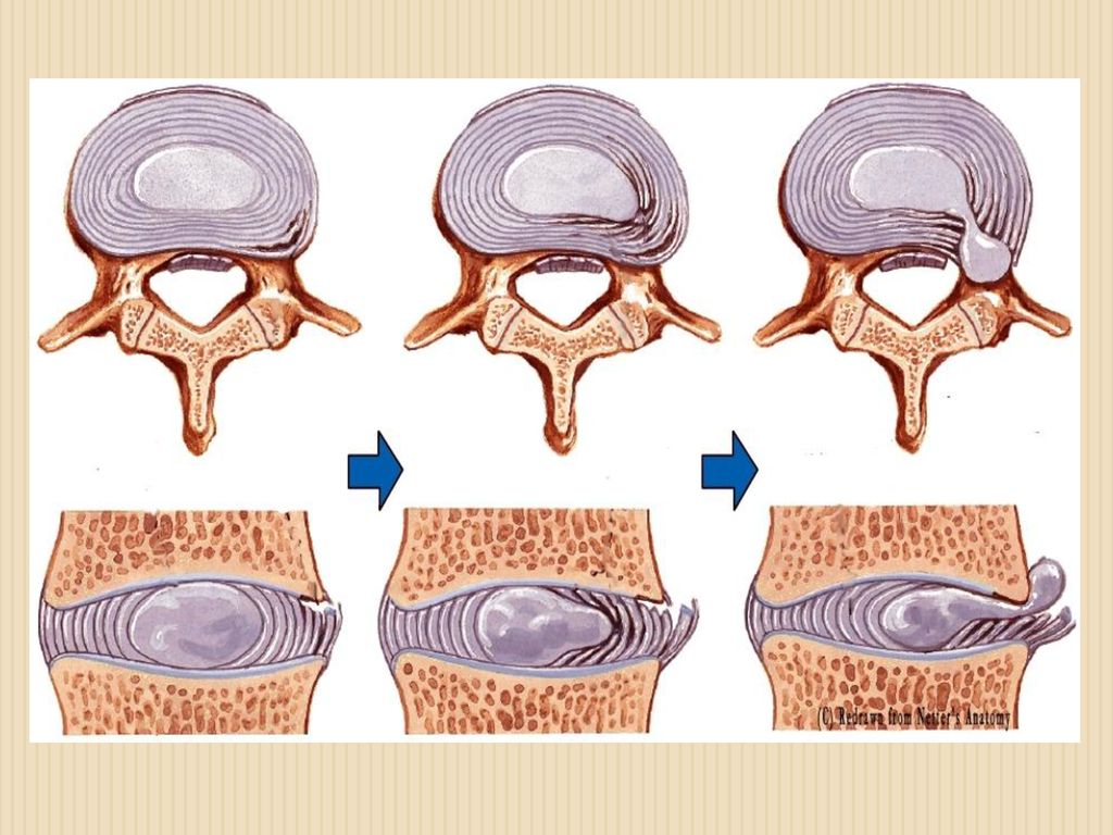 hogyan kell kezelni a deformáló arthrosist osteochondrosis hátfájás
