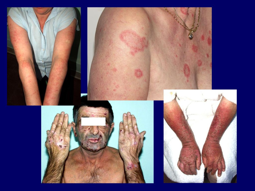 Vitiligo és társbetegségei