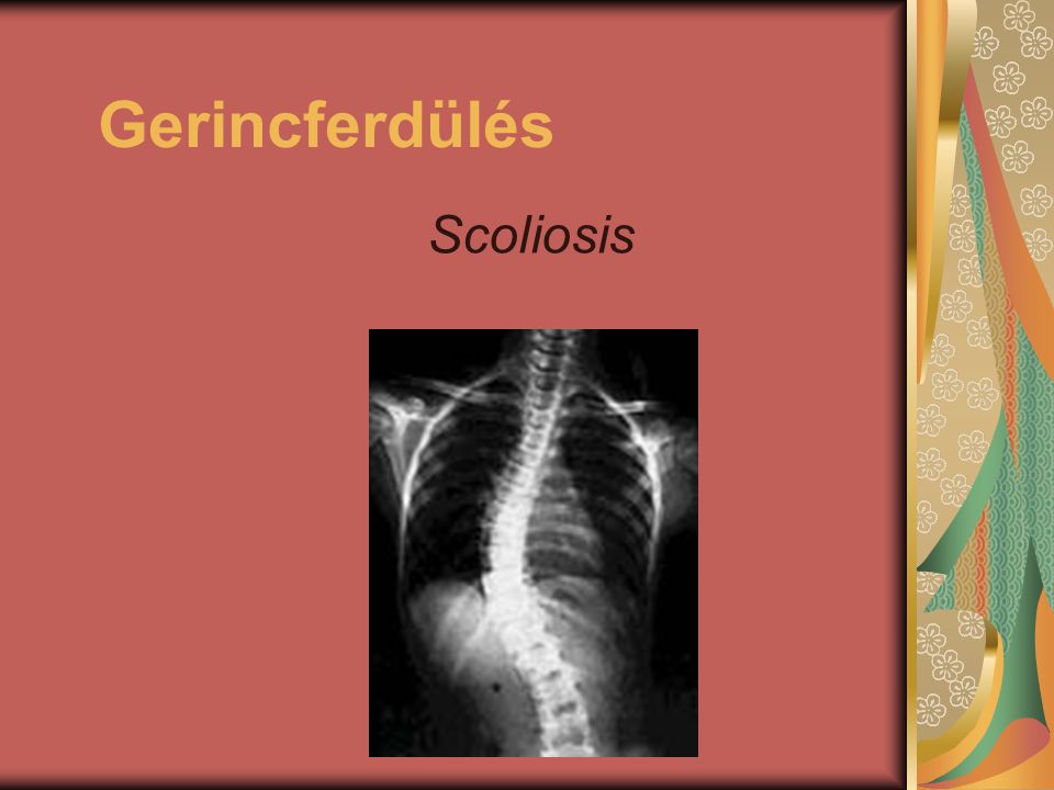 Gerincferdules Scoliosis Ppt Letolteni