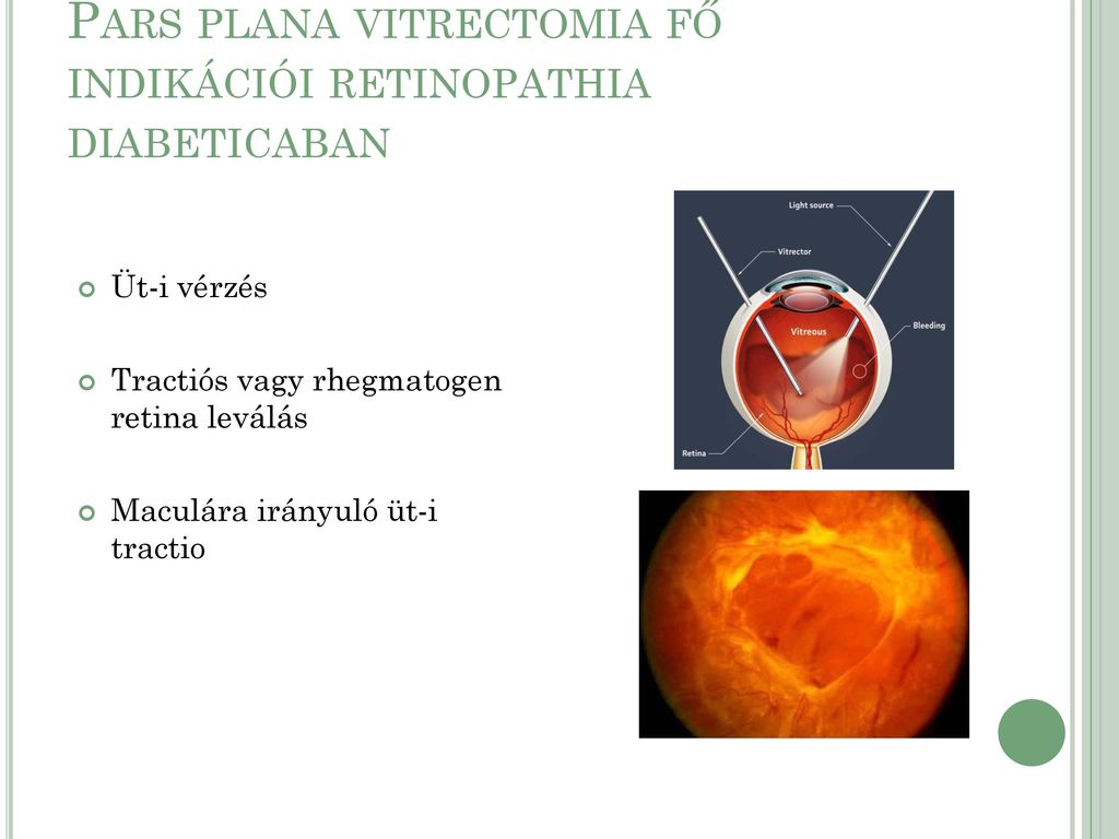 Látászavar, ideghártya vérzés, háttér retinopathia és retinális elváltozások