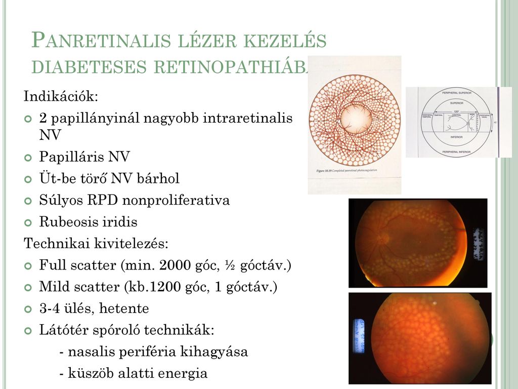 A diabéteszes retinopátia és tünetei