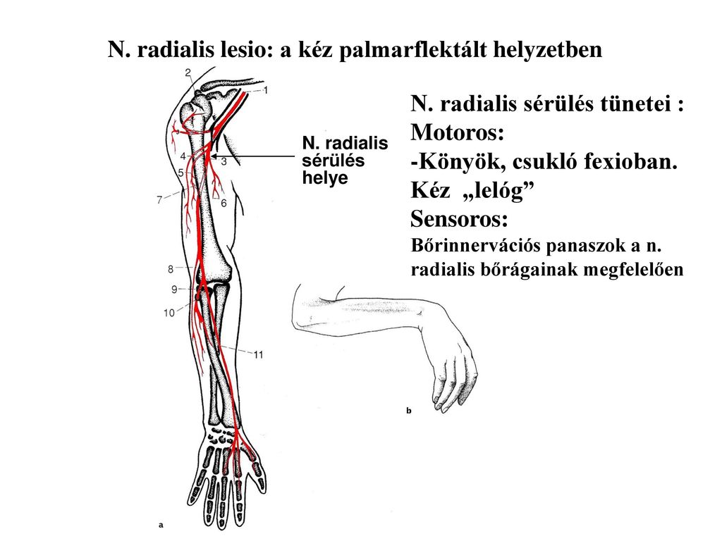 N. radialis lesio: a kéz palmarflektált helyzetben