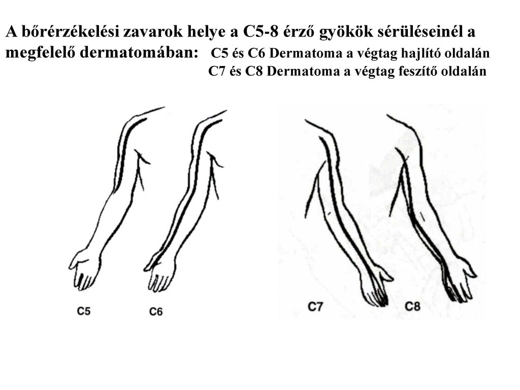 A bőrérzékelési zavarok helye a C5-8 érző gyökök sérüléseinél a megfelelő dermatomában: C5 és C6 Dermatoma a végtag hajlító oldalán C7 és C8 Dermatoma a végtag feszítő oldalán