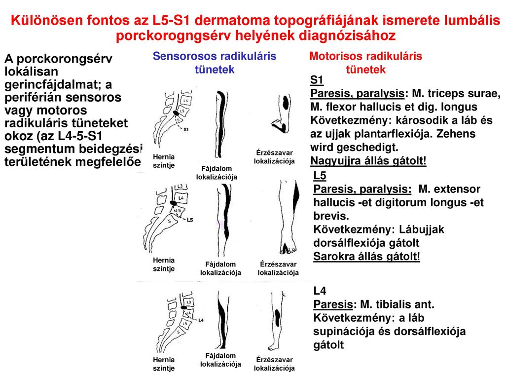 Különösen fontos az L5-S1 dermatoma topográfiájának ismerete lumbális porckorogngsérv helyének diagnózisához