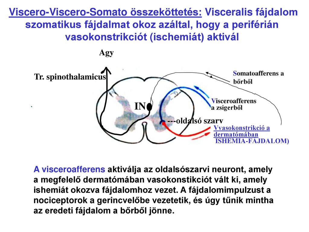 Viscero-Viscero-Somato összeköttetés: Visceralis fájdalom szomatikus fájdalmat okoz azáltal, hogy a periférián vasokonstrikciót (ischemiát) aktivál