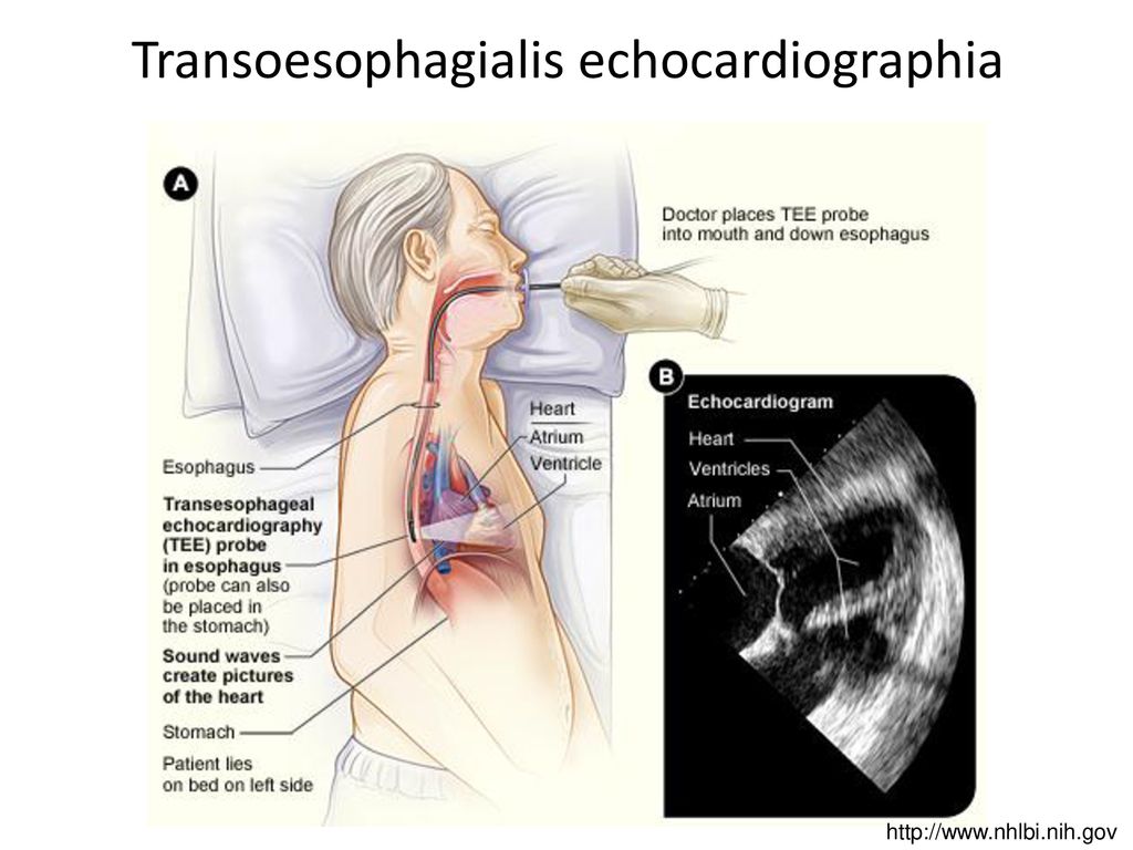 Эхо кг сердца что. Показаниями для проведения чреспищеводной эхокардиографии.