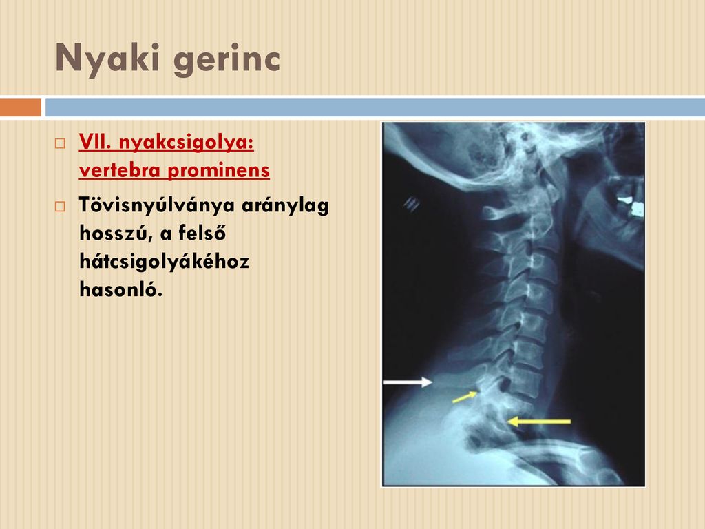 Nyaki gerinc VII. nyakcsigolya: vertebra prominens