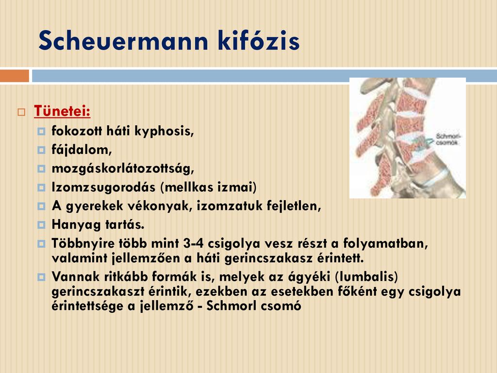 Scheuermann kifózis Tünetei: fokozott háti kyphosis, fájdalom,