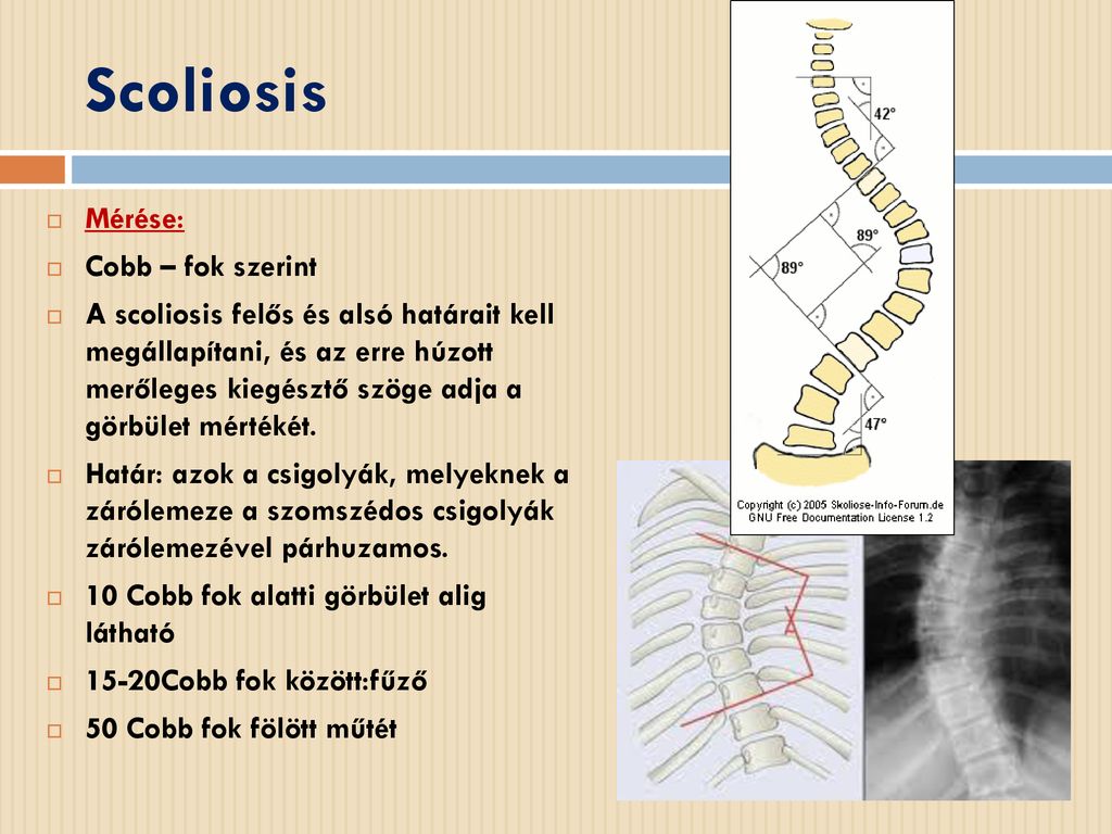 Scoliosis Mérése: Cobb – fok szerint