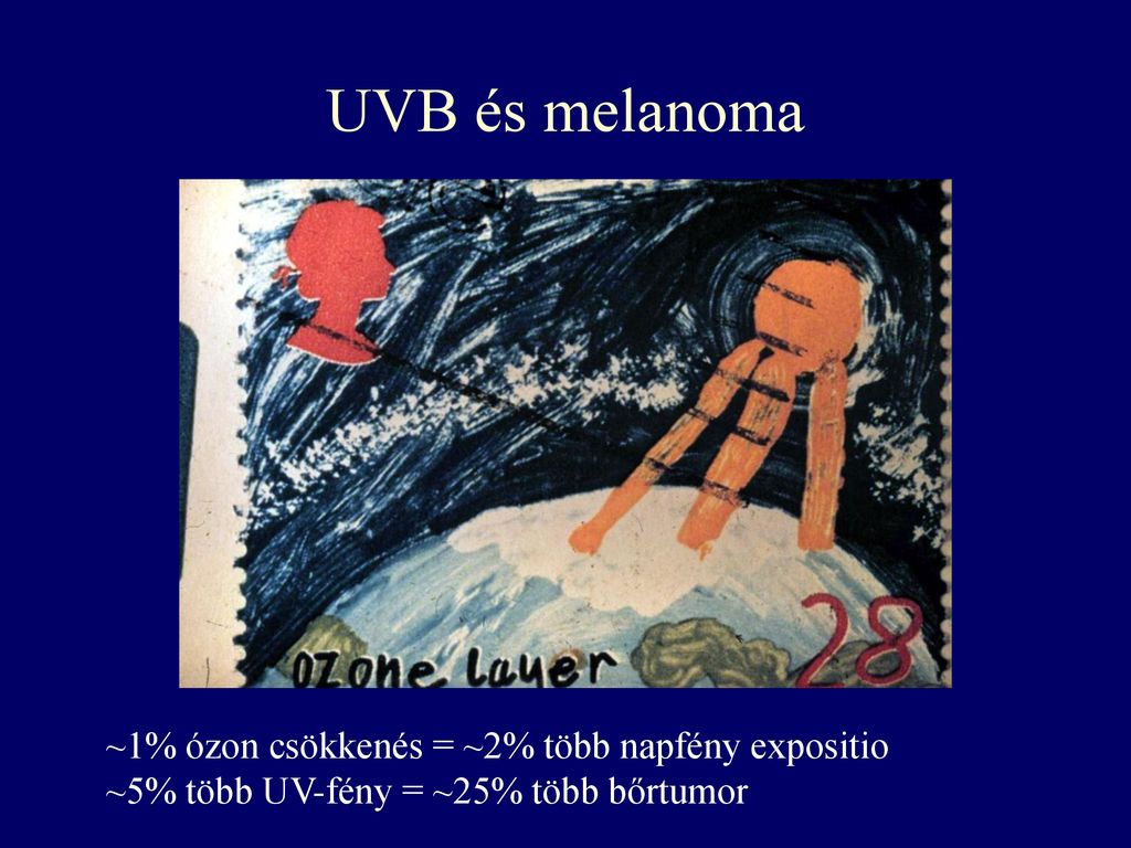 UVB és melanoma ~1% ózon csökkenés = ~2% több napfény expositio