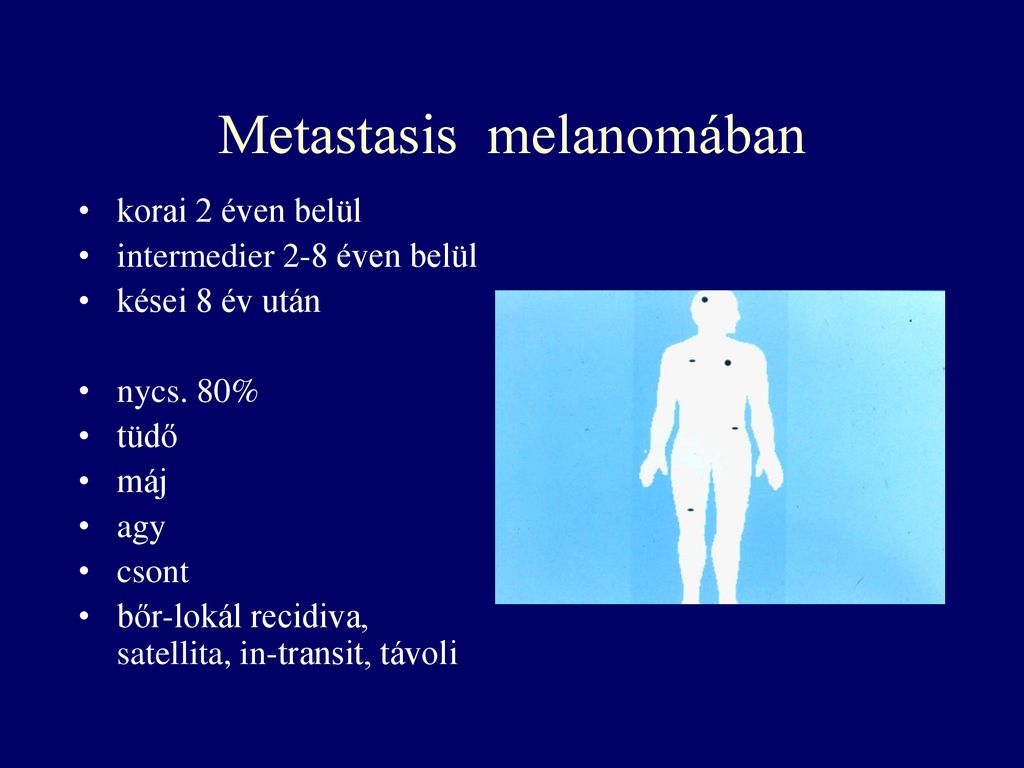 Metastasis melanomában
