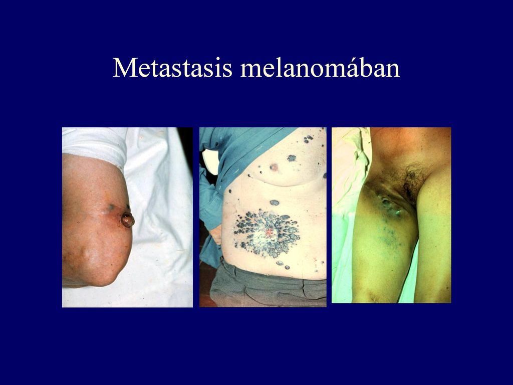 Metastasis melanomában