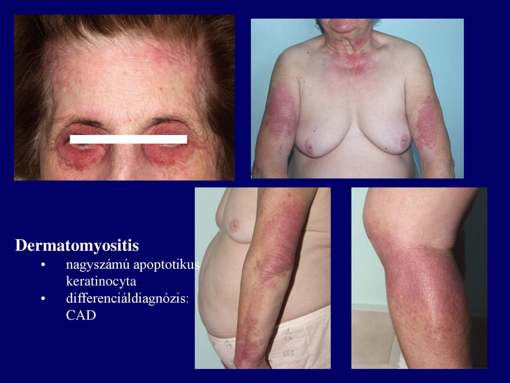 Dermatomyositis nagyszámú apoptotikus keratinocyta
