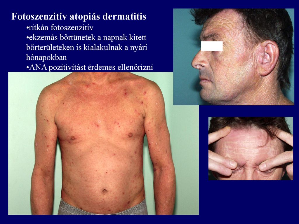Fotoszenzitív atopiás dermatitis